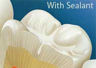 Protected tooth with Sealant